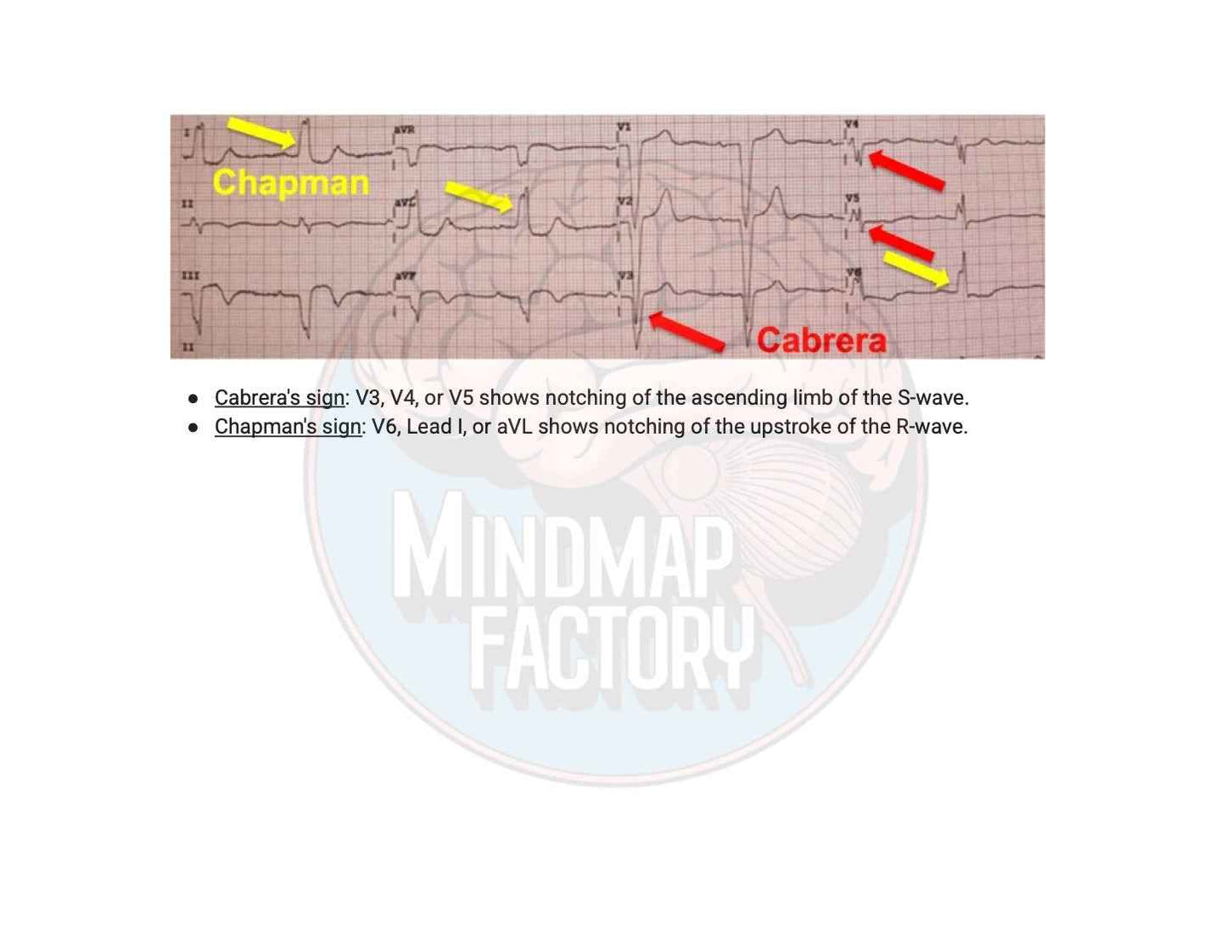 ECG Decoded: A Pattern-Based Approach